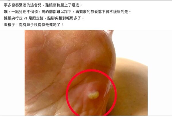 不速之客——雞眼太太