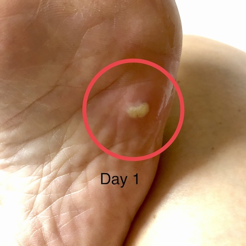 雞眼精油 Day 1